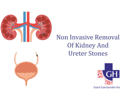 Non Invasive Removal Of Kidney And Ureter Stones