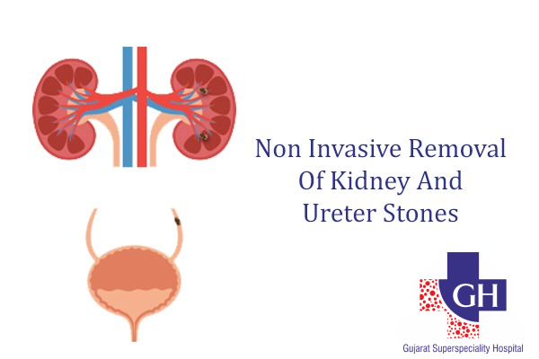 Non Invasive Removal Of Kidney And Ureter Stones