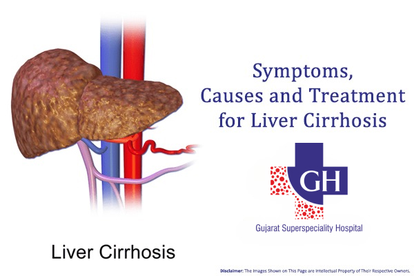 Symptoms, Causes and Treatment for Liver Cirrhosis