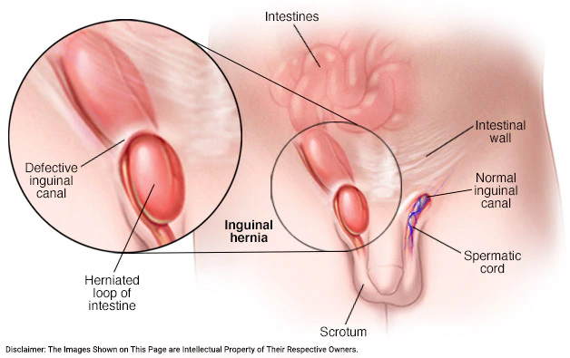 What is Hernia