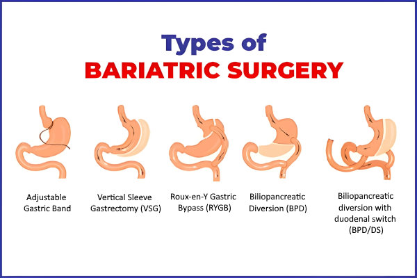 Types-of-Bariatric-Surgery - types of weight loss surgery