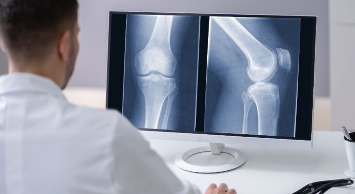 Medical Conditions that Require a Knee Replacement Surgery