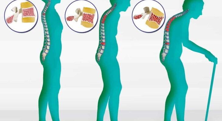 What is Osteoporosis and Why You Should be Tested?