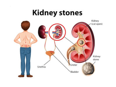 Kidney Stone and its type